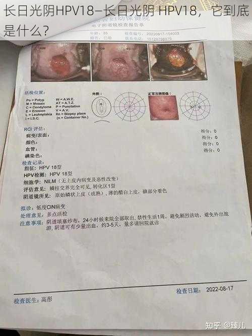 长日光阴HPV18—长日光阴 HPV18，它到底是什么？